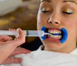 Tooth-Whitening-Procedure1