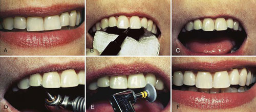 procedure